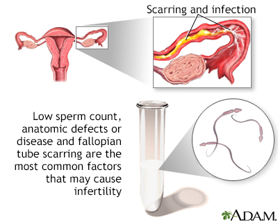 Infertility Factors