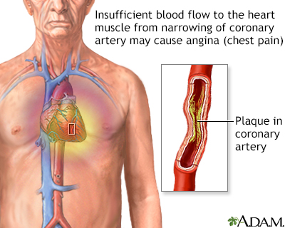 White Angina