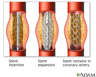 Coronary artery stent