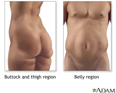Excess weight